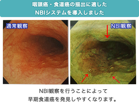 NBI観察を行うことによって早期食道癌を発見しやすくなります。